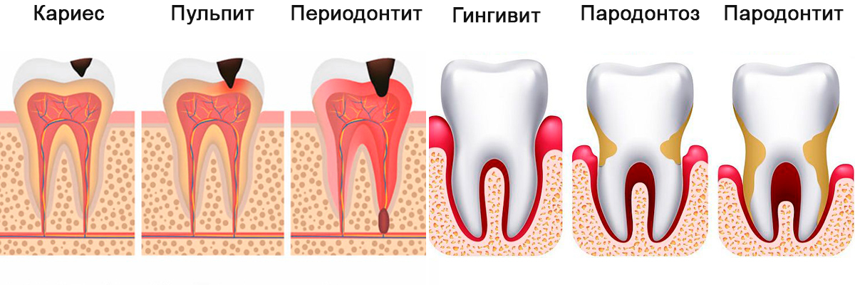 причины зубной боли