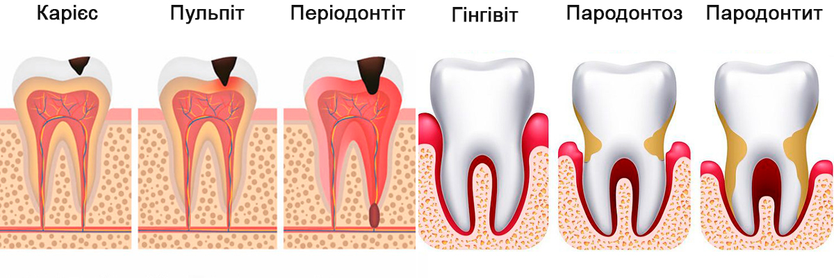 причини зубного болю