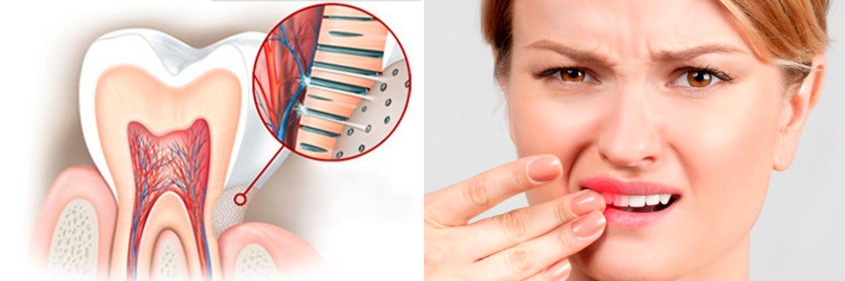 оголена шийка зуба - часта причина чутливості зубів